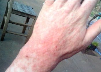 Autoridad sanitaria informa medidas por brote de sarna humana en el sur de la región.