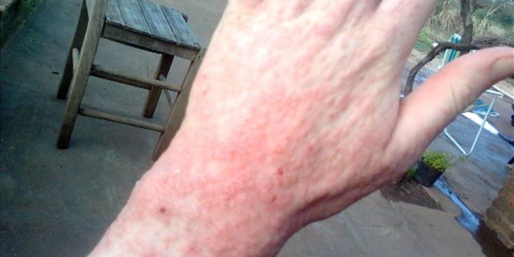 Autoridad sanitaria informa medidas por brote de sarna humana en el sur de la región.