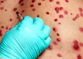 Chile se blinda ante la viruela del mono: Alerta Sanitaria por nueva variante más agresiva
