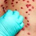 Chile se blinda ante la viruela del mono: Alerta Sanitaria por nueva variante más agresiva