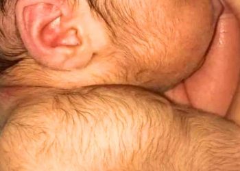 España alerta por medicamento para alopecia que se comercializa en Chile, generaría «Síndrome del Hombre Lobo» en bebés